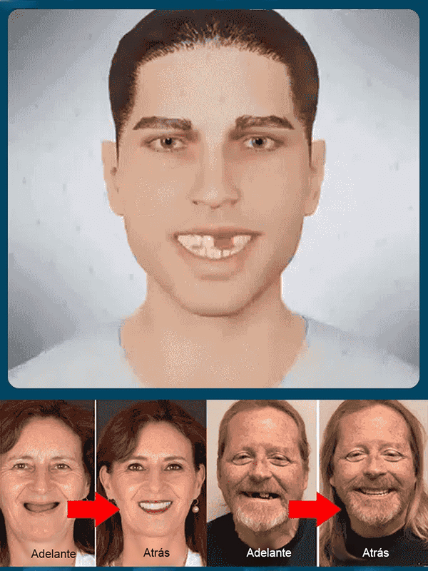 【Recomendación oficial de EE.UU.】Perfecta sonrisa con dentadura postiza