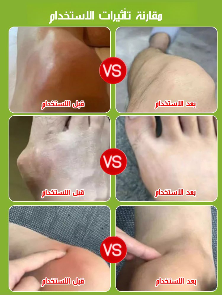 كريم مضاد للالتهابات ومسكن للألم لعلاج التهاب المفاصل والنقرس