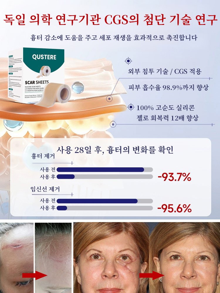 24시간 지속 흉터 완화 실리콘 젤 흉터 패치