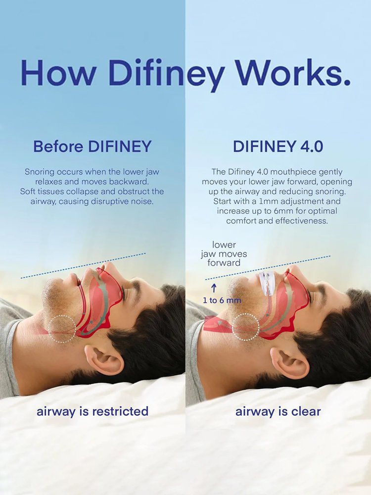 [Doctor Recommended] Professional Smart Anti-Snoring Device