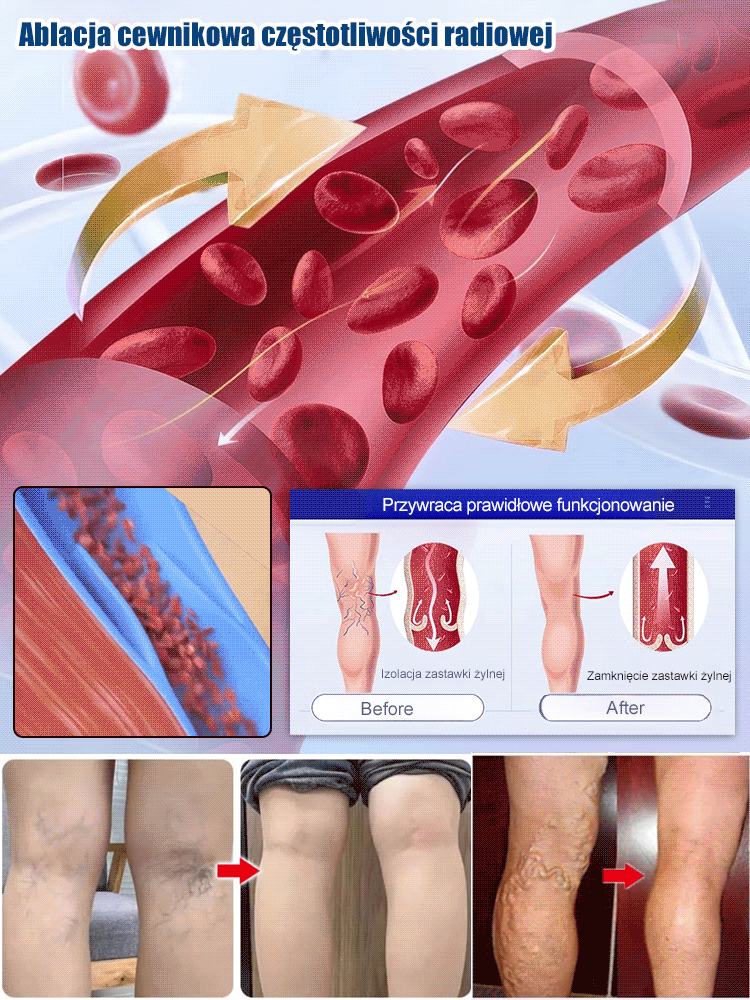 Spray do pielęgnacji żył nóg