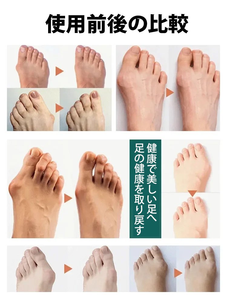 【最新モデル】外反母趾サポーター