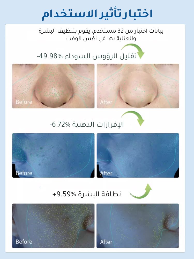 جهاز تجميل كهربائي لشفط الرؤوس السوداء (الحفاظ على نظافة البشرة)