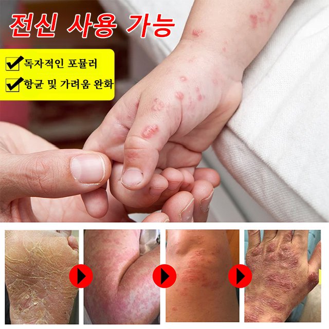 자화지정 피부 가려움 완화 크림