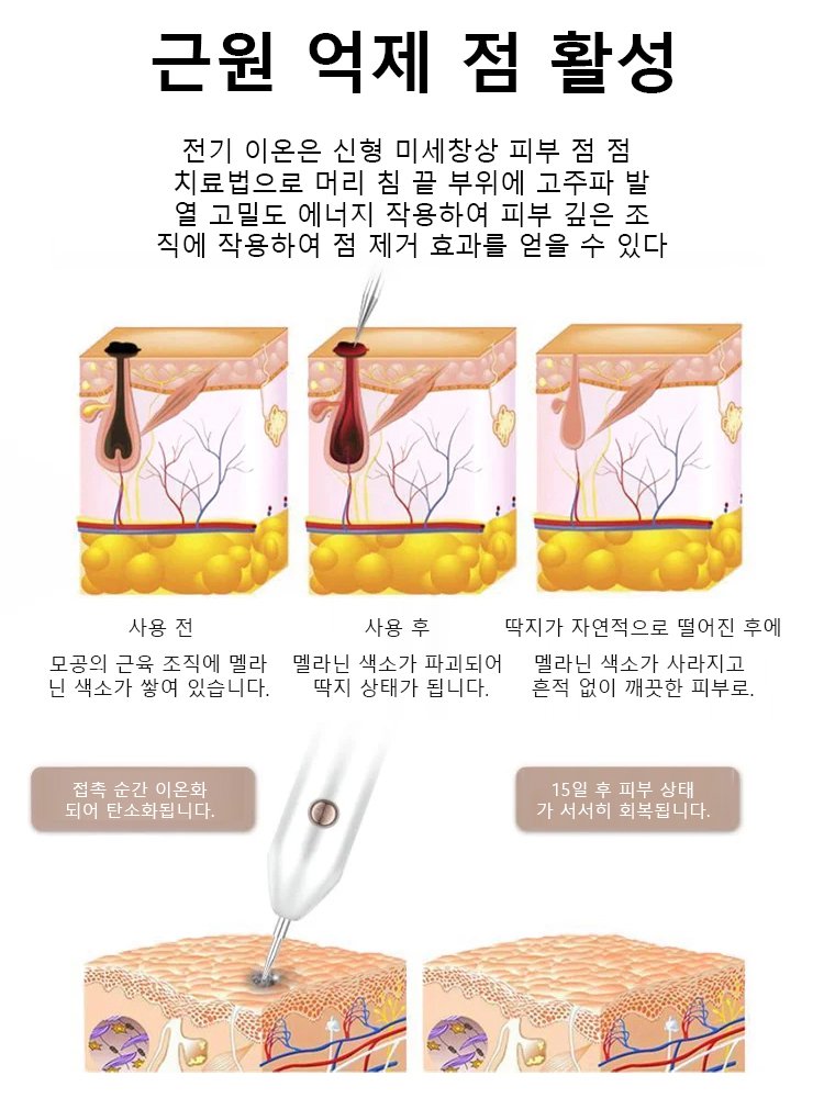 레이저 무통 사마귀 제거 펜