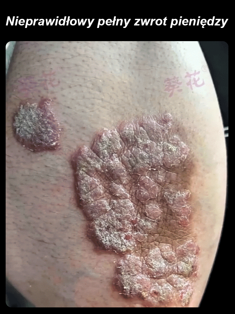 【Pogromca egzemy】Płynny opatrunek do pielęgnacji skóry