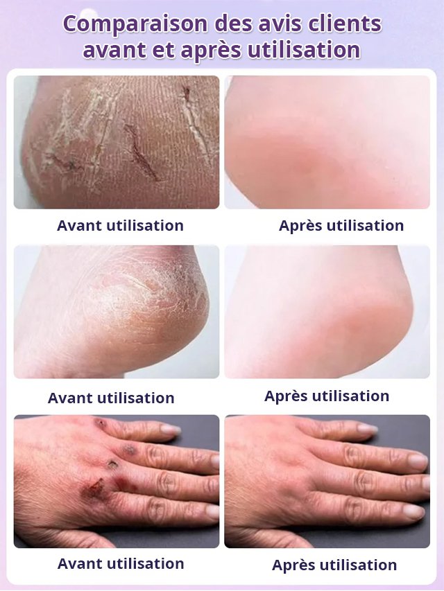 【Élimination des callosités de dix ans】Sérum exfoliant pour les pieds