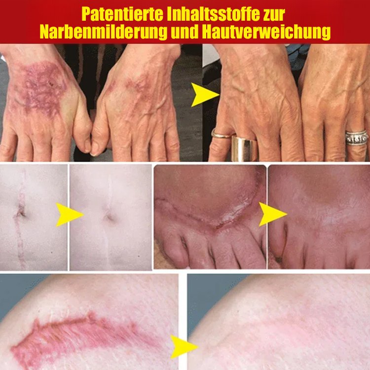 Hochwirksames Narbenreparaturgel