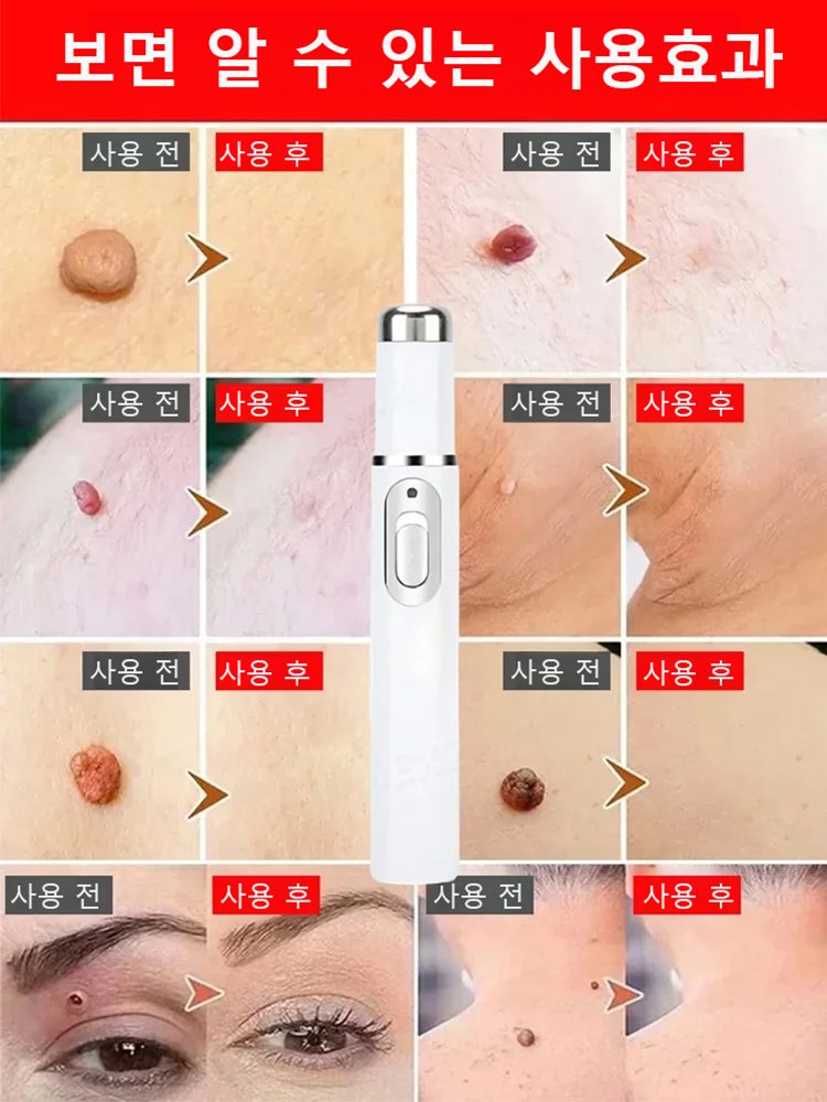 레이저 무통 사마귀 제거 펜