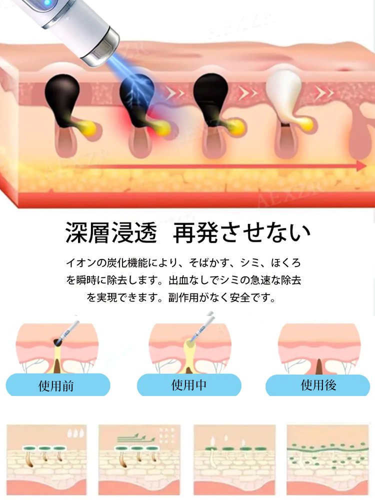 レーザーイボ取り美顔ペン