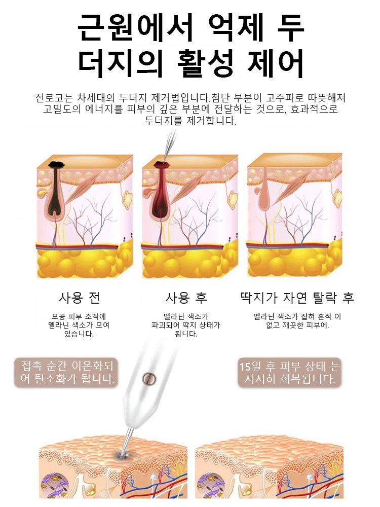 레이저 무통 사마귀 제거 펜
