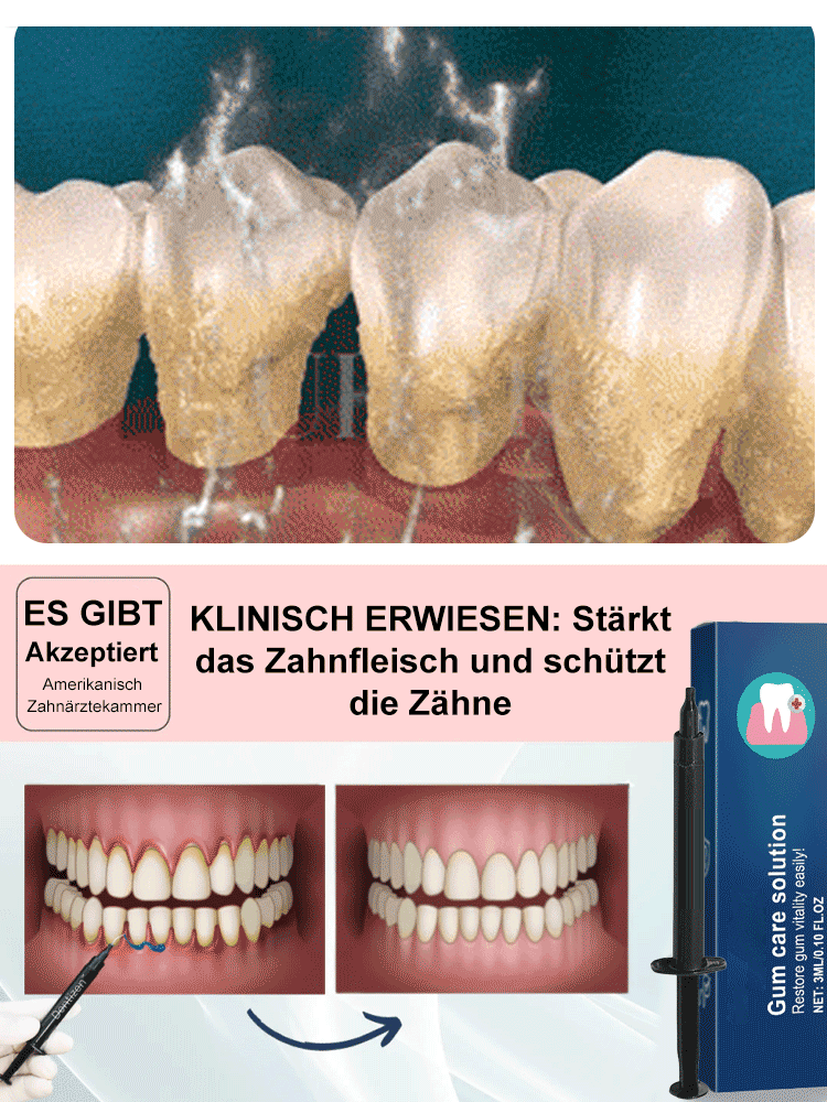 Oralhoe Zahnfleischschutzmittel
