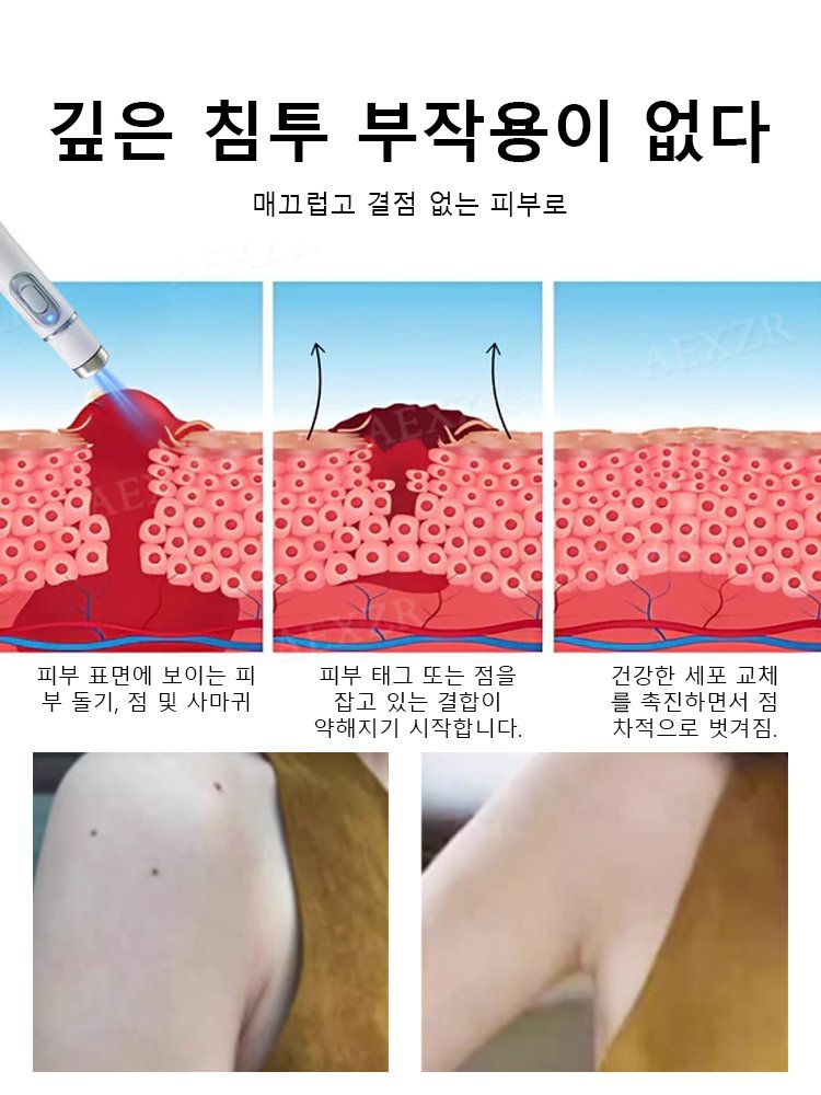 레이저 무통 사마귀 제거 펜