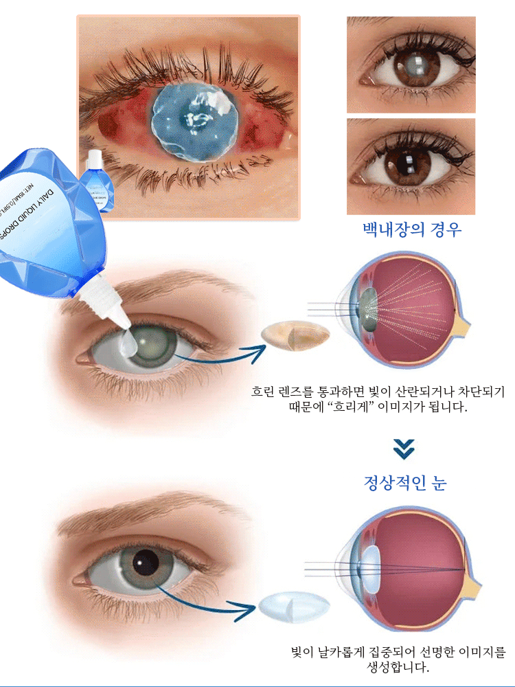 시력 교정 및 보습 점안액