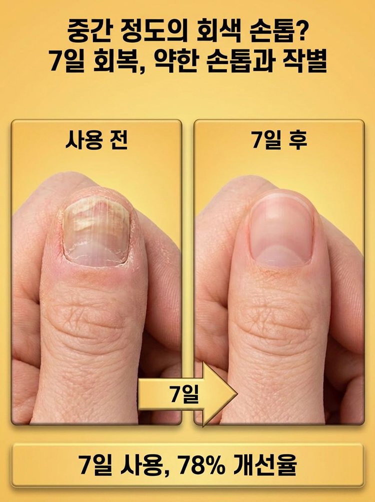 [7일 기적] 갈아낼 필요 없는 문제성 발톱 뿌리 파괴 벌독 앰플