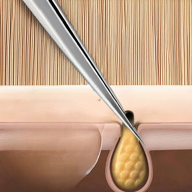 스테인리스 스틸 셀 클립 여드름 바늘 세트