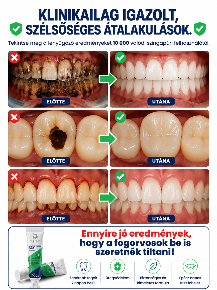 【1 másodperc alatt eltávolítja a 10 éves sárga lepedéket】Rothadt fogak újjászületése probiotikus fog
