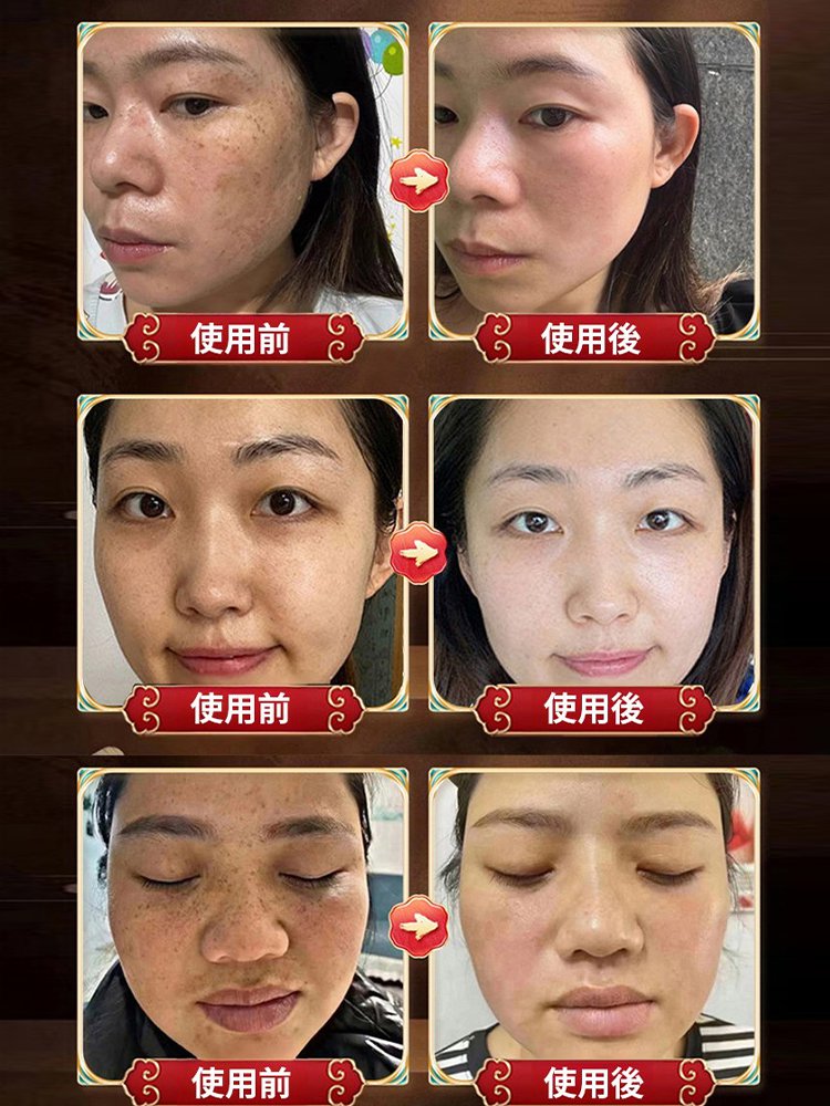 兩週吸走黑斑淡斑抗皺面膜