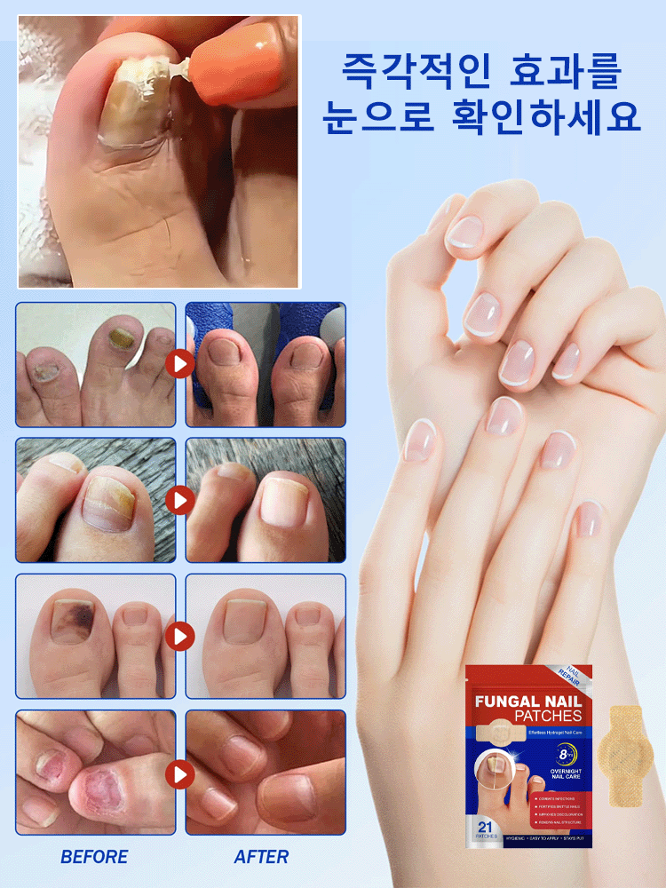 손톱 케어 교정 항균 패치