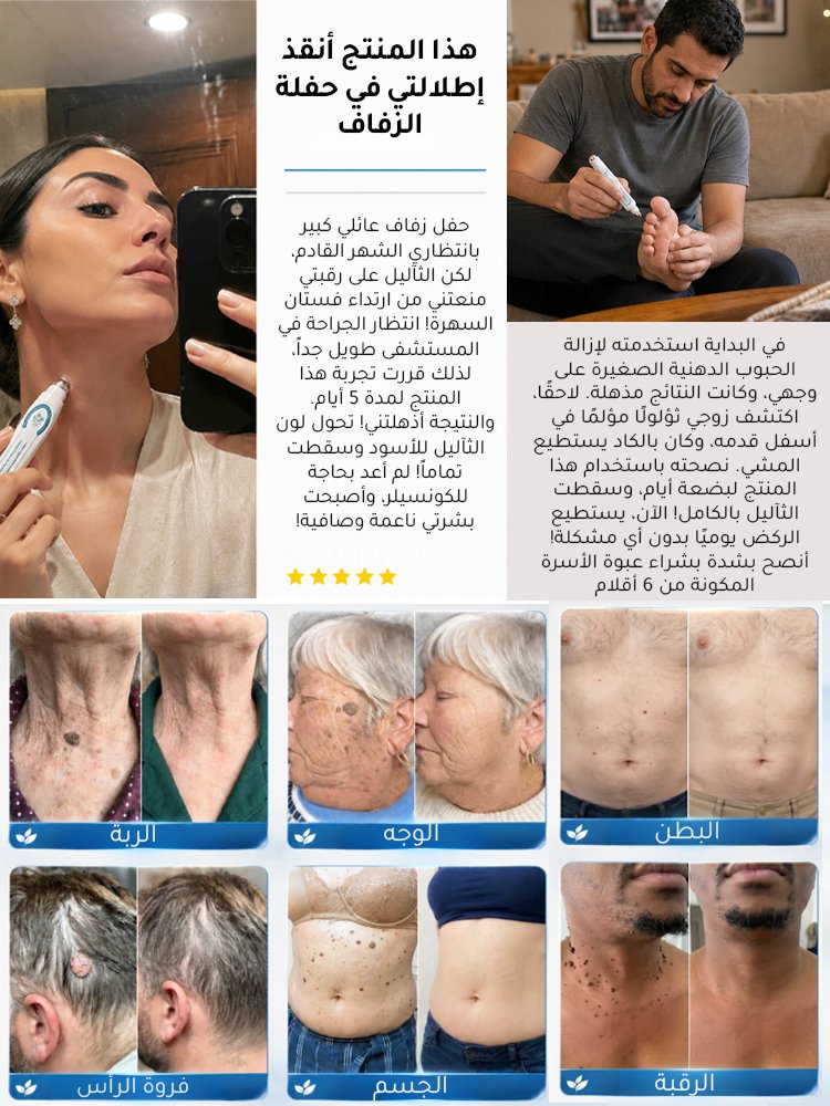 سيروم نباتي لإزالة الثآليل والبقع الداكنة مع أداة وضع كروية دقيقة