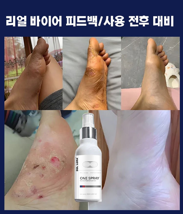 발 진균 관리 스프레이