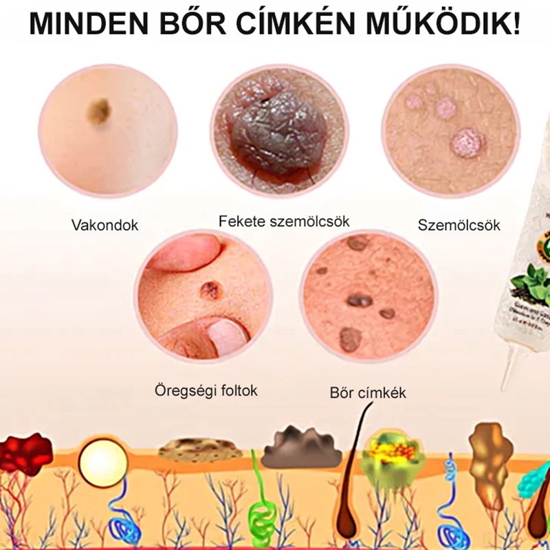 Eelhoe szemölcseltávolító kenőcs