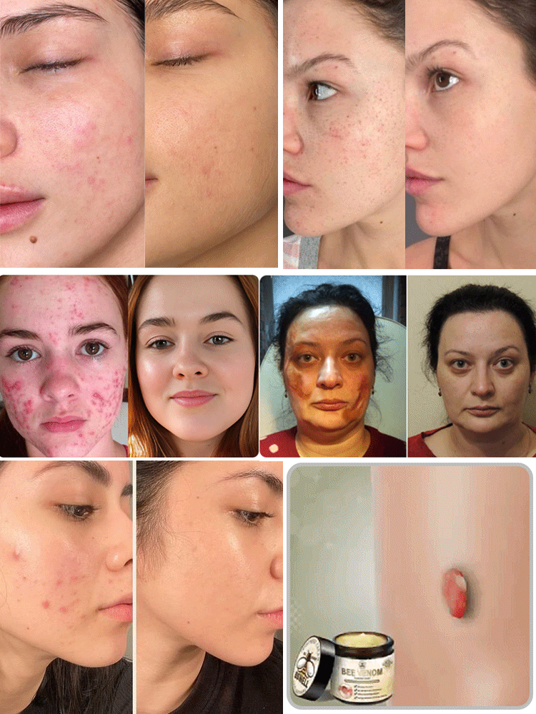 Huidherstellende Crème voor Vlekken en Littekens