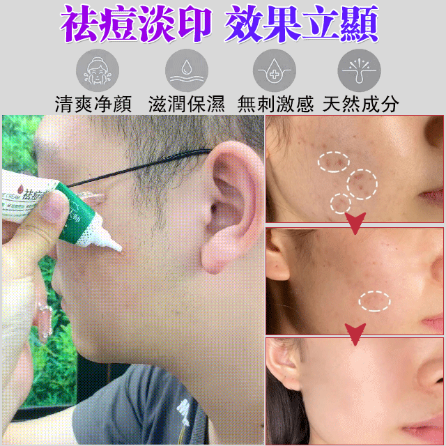 植物大師祛痘膏