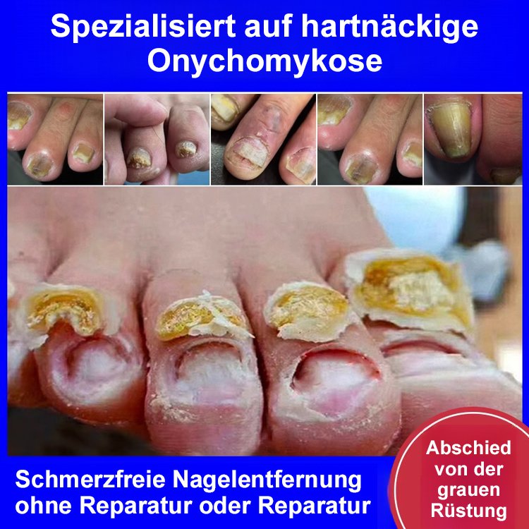 [Schmerzlos und kein Wiederauftreten] Onychomykosesalbe