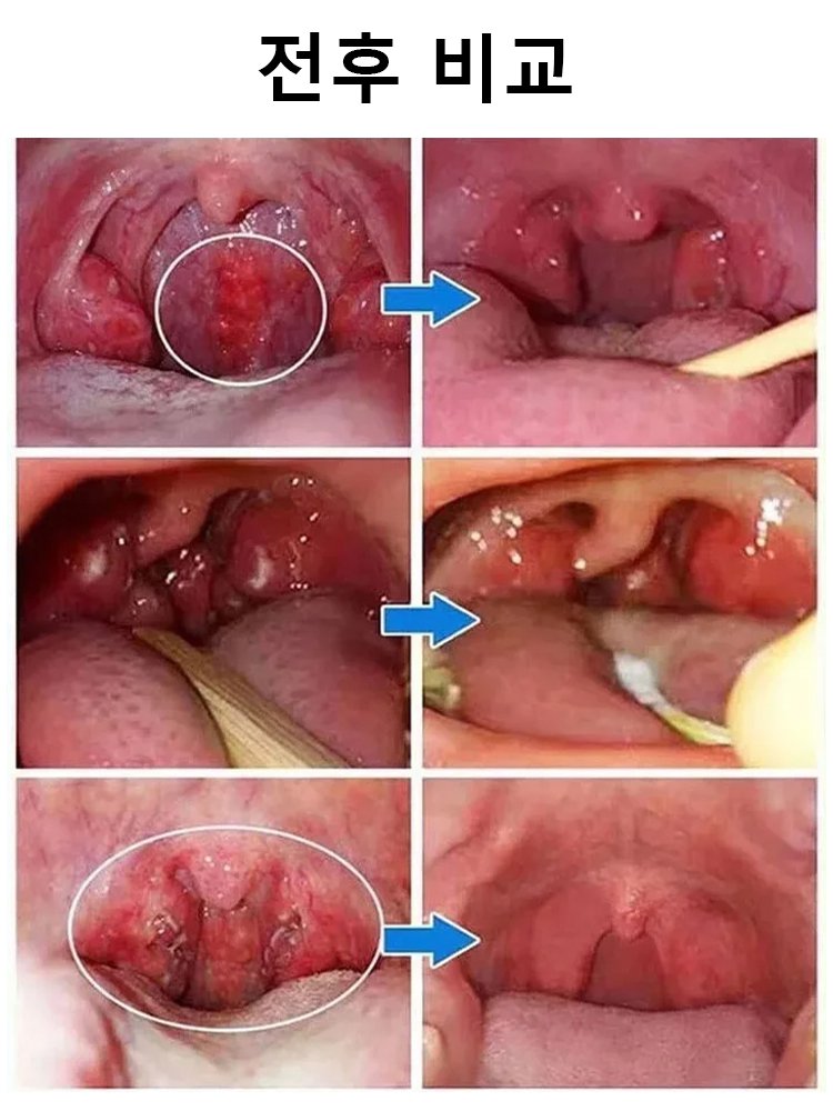 【폐 클리너】목 건강과 폐 정화 해독제