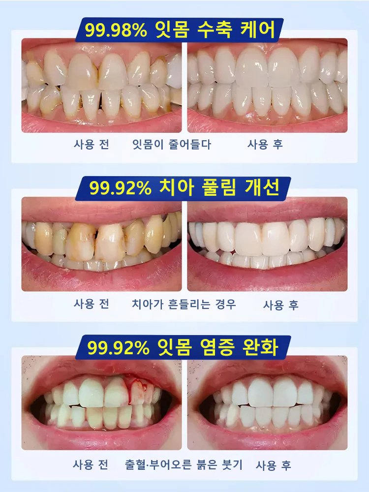 정상 국립대 개발 치아 회복액, 병원·시술 없이 하루 몇 방울로 충치 회복과 시린 이 완화!