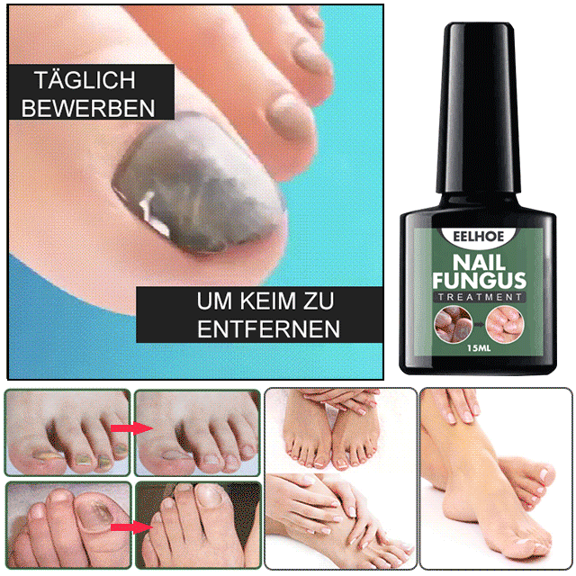 Flüssigkeit zur Behandlung von Nagelpilz