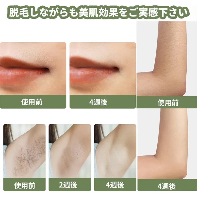 美容外科学会推薦！【男女兼用】スマート無痛脱毛機！脱毛・美肌・黒ずみケア