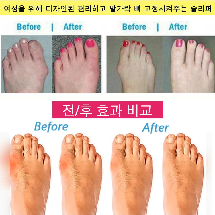 신상 웨지힐 엄지 교정 슬리퍼